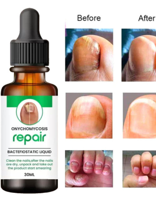 Nail Repair Serum Buy 1 Get 1 Free